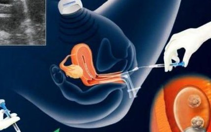 东莞地区有哪些私立的机构可以做试管技术？雄性激素过高的女生是什么原因？